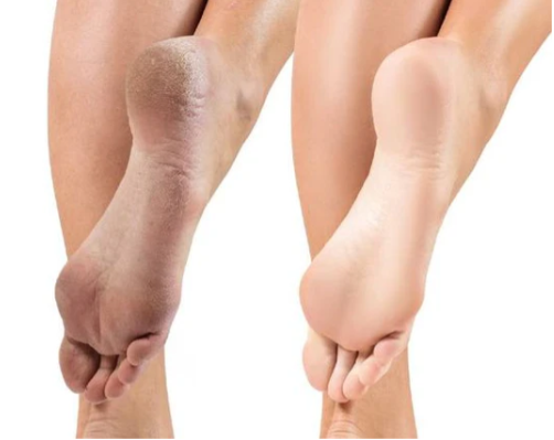TRAJTIMI I THELLE ME MJETE MJEKESORE + ESTETIK [trajtimi i thelle i kembes me myk ,kallo dhe mish ne thua] - MEDICAL + AESTHETIC TREATMENT FOOT [with callus mold and flesh in the claw]