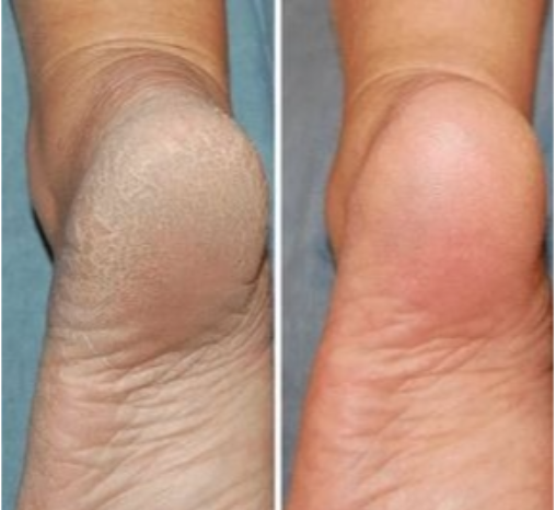 TRAJTIMI I THELLE ME MJETE MJEKESORE + ESTETIK [trajtimi i thelle i kembes me myk ,kallo dhe mish ne thua] - MEDICAL + AESTHETIC TREATMENT FOOT [with callus mold and flesh in the claw]