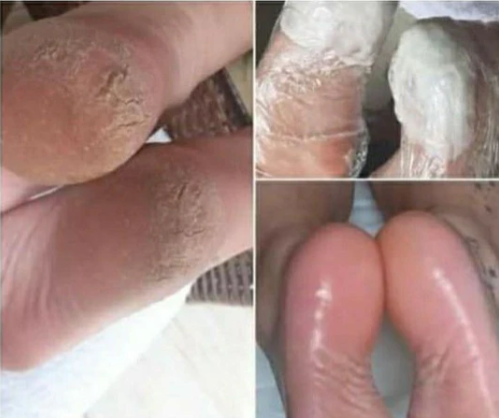 TRAJTIMI I THELLE ME MJETE MJEKESORE + ESTETIK [trajtimi i thelle i kembes me myk ,kallo dhe mish ne thua] - MEDICAL + AESTHETIC TREATMENT FOOT [with callus mold and flesh in the claw]